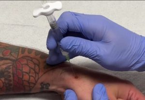 musculoskeletal injury injection site